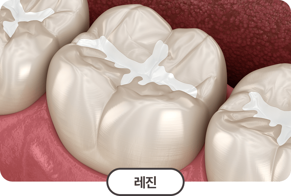 레진