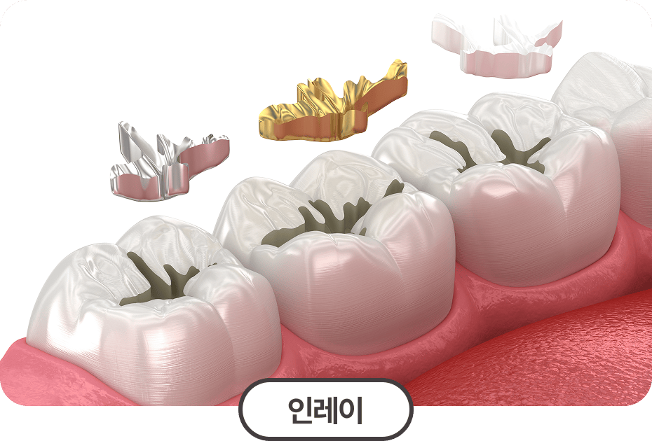 인레이