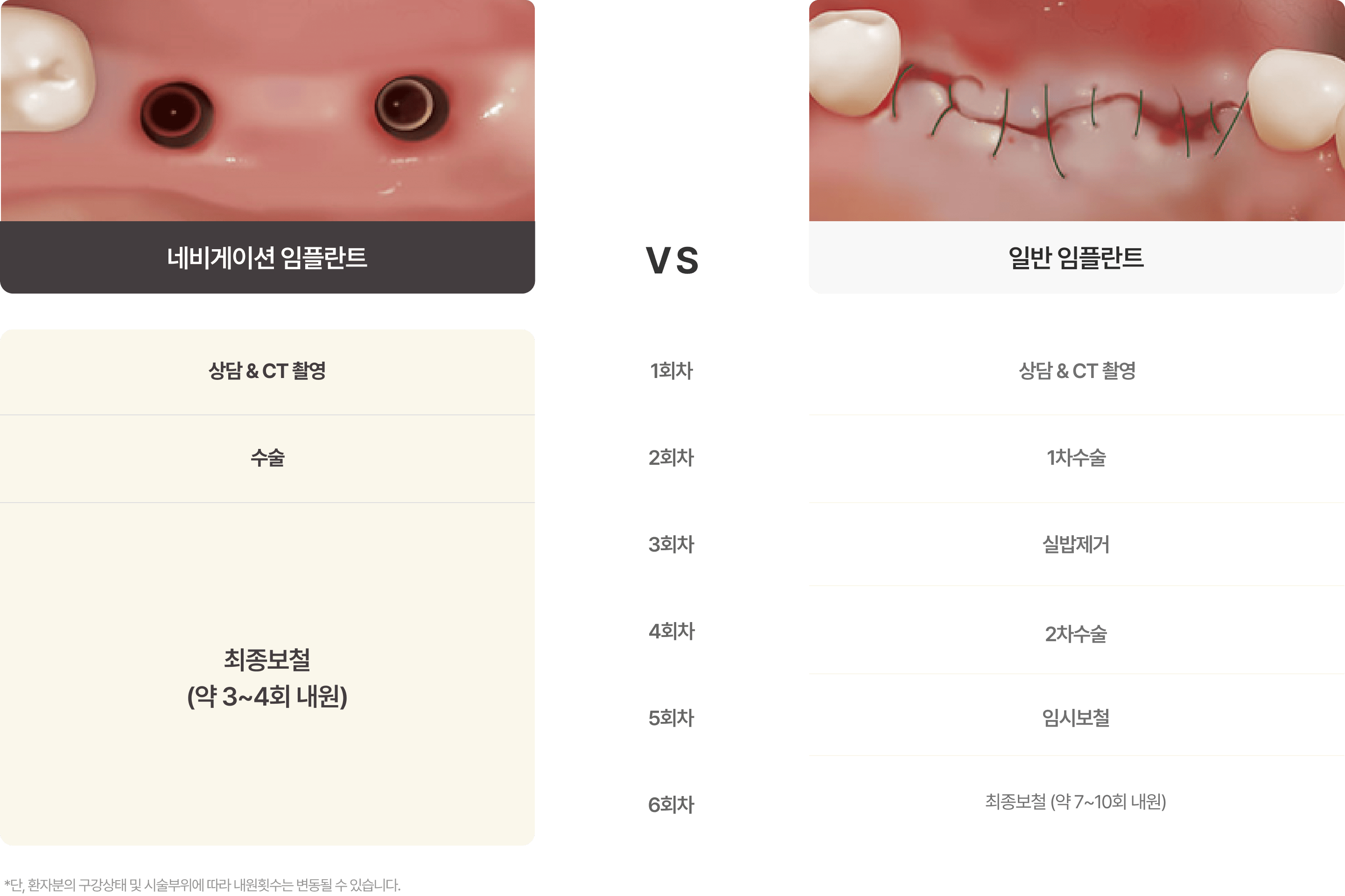 네비게이션 임플란트와 일반 임플란트의 차이점
