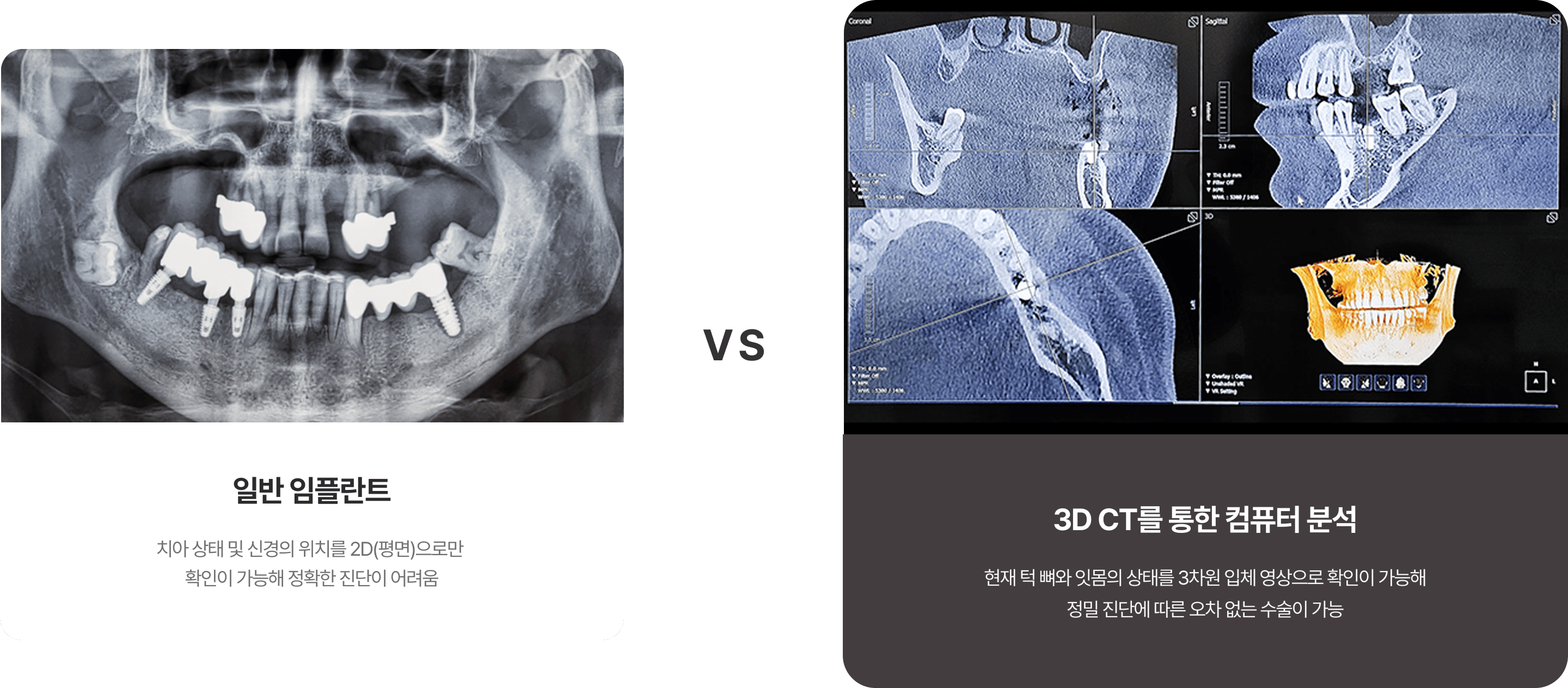 치아 상태 및 신경의 위치를 2D(평면)으로만 확인이 가능해 정확한 진단이 어려운 일반 임플란트와 현재 턱 뼈와 잇몸의 상태를 3차원 입체 영상으로 확인이 가능해 정밀 진단에 따른 오차 없는 수술이 가능한 네비게이션 임플란트